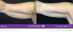 trusculpt arms before and after